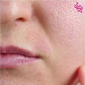 پوست حساس تشخیص ویژگی های پوست حساس | پری رو
