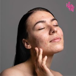 پوست چرب پوست چرب | پری رو